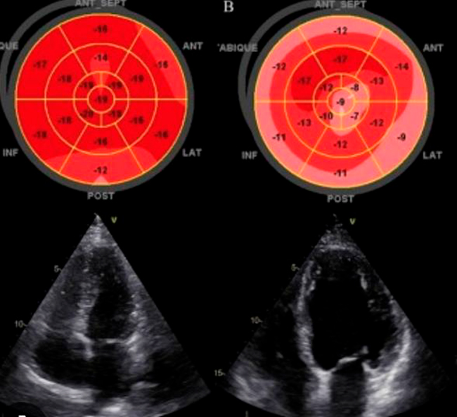 Cuándo Realizar un Ecocardiograma en un Deportista