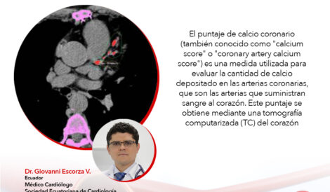 Utilidad del score de calcio coronario en medicina y cardiología