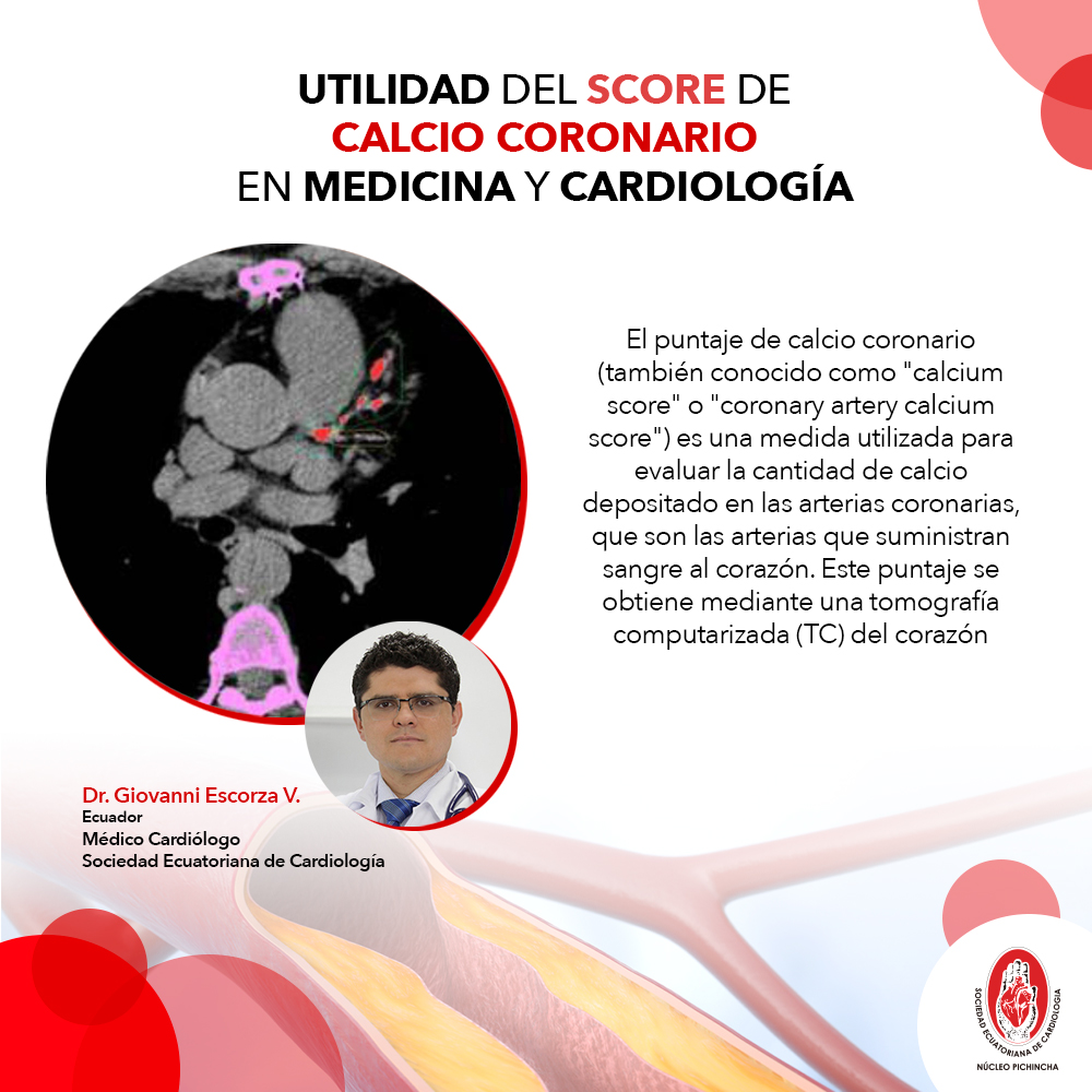 Utilidad del score de calcio coronario en medicina y cardiología